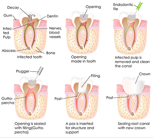 Placerville Root Canal