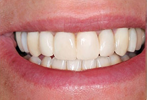Placerville Before and After Teeth Whitening