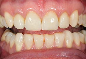 Gold Country Before and After Teeth Whitening