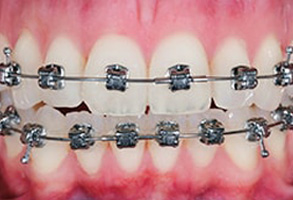 Placerville Before and After Braces