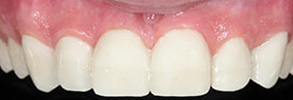 Greenstone Before and After Crown Lengthening