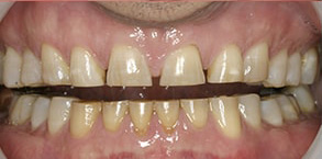 Gold Country Before and After Teeth Whitening