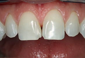 Placerville Before and After Teeth Whitening