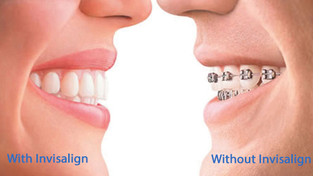 Dental Bonding and You - Placerville Dental Group